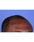 Before Hair Transplant&nbsp;Front